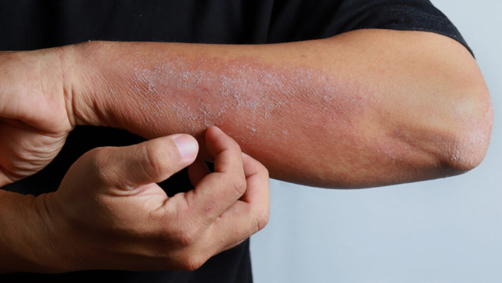 Allergic Reactions