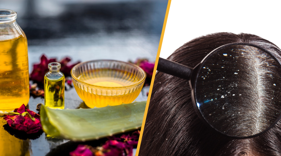 10 Home Remedies For Dandruff That Actually Work! - Blog