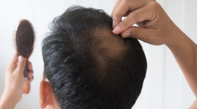 Hair Fall Reasons In Men & Its Effects - Healthkart Blog