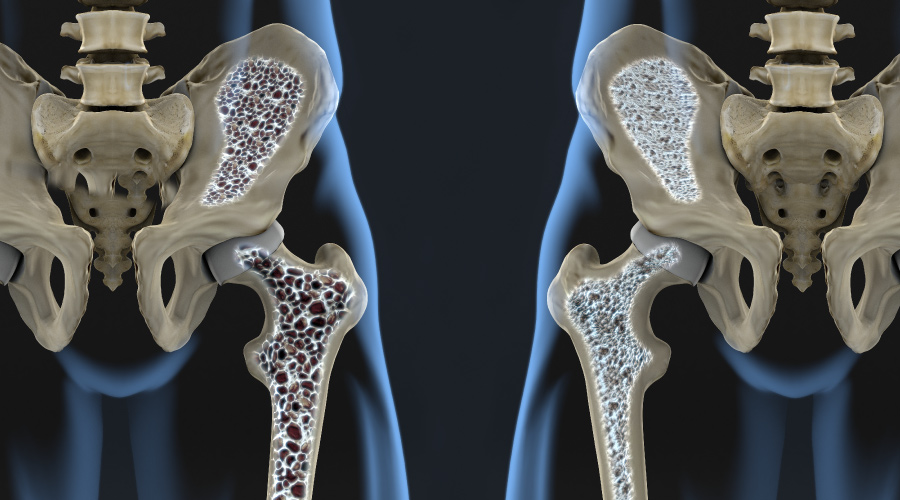 5 Lesser-Known Minerals That Can Reduce Your Risk Of Osteoporosis bone density