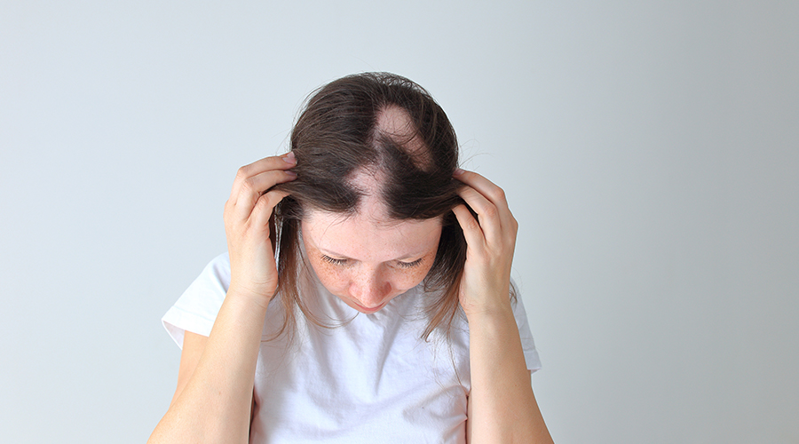 5 Home Remedies to Help Treat Traction Alopecia Traction alopecia