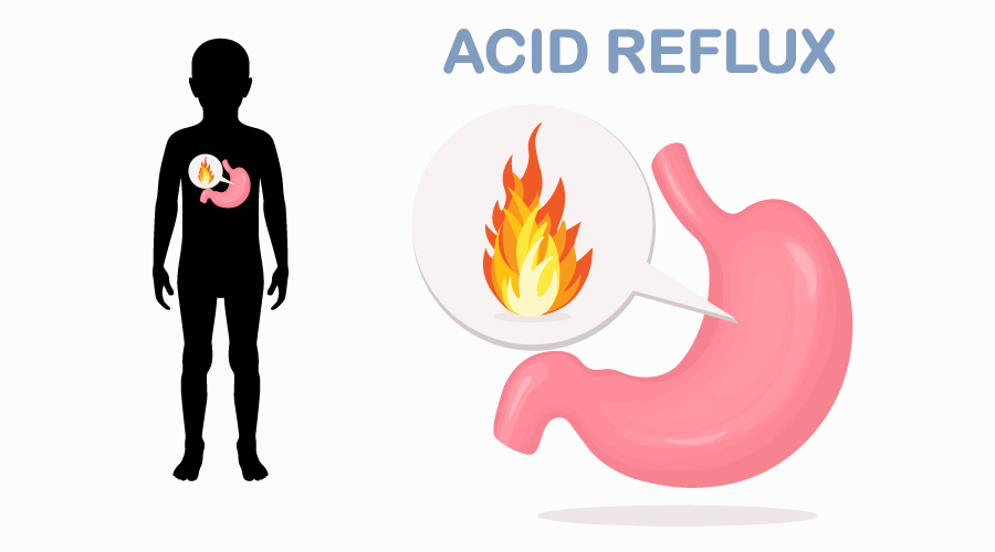 Best Home Remedies for Acid Reflux Home Remedies for Acid Reflux