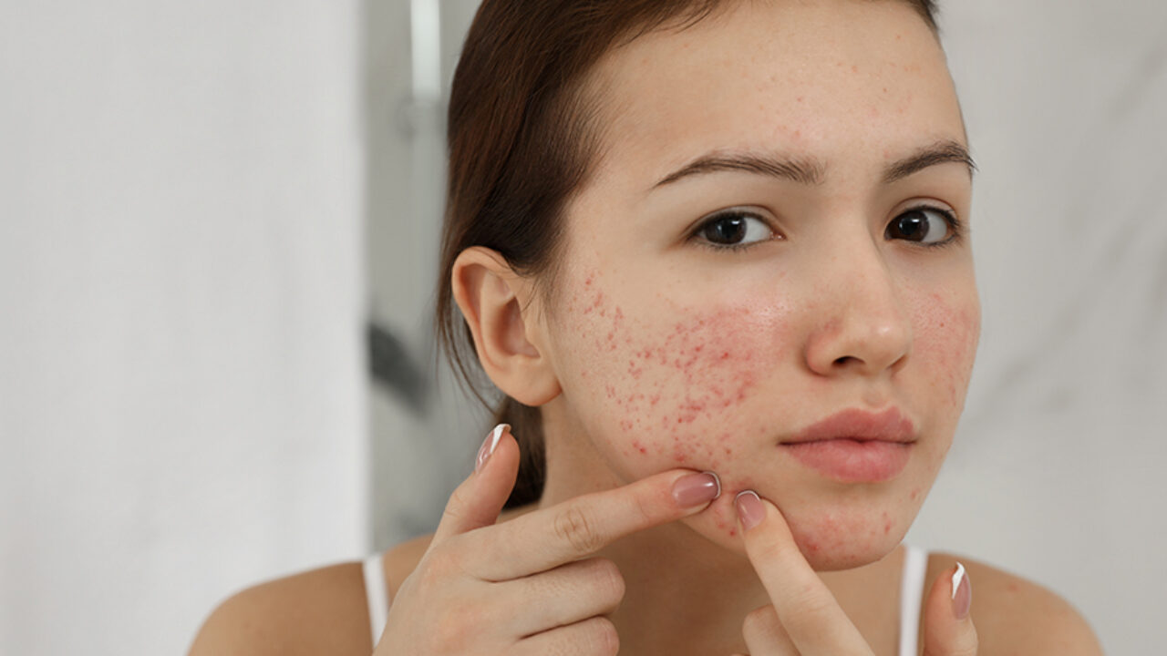 Treatment of Freckles, Dark Spots, and Scars || Hyperpigmentation Treatment