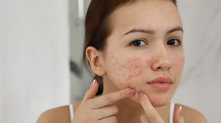Treatment for Pimples You Can Try at Home HealthKart
