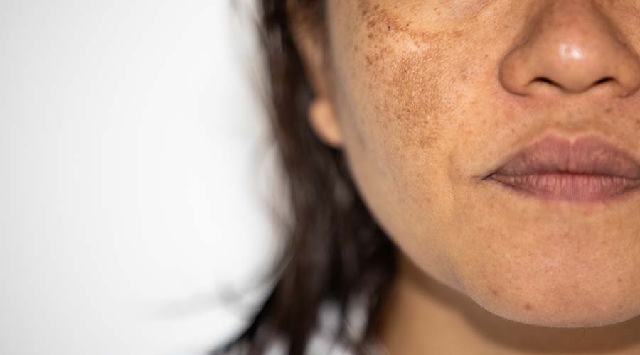 Treating Hyperpigmentation Vitamins that May Help HealthKart