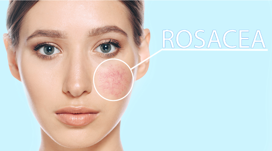 Rosacea Treatment Healing the Redness of the Skin HealthKart