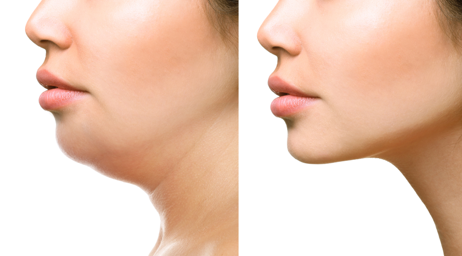 Wondering How to Reduce Double Chin? This is for You! How to reduce double chin