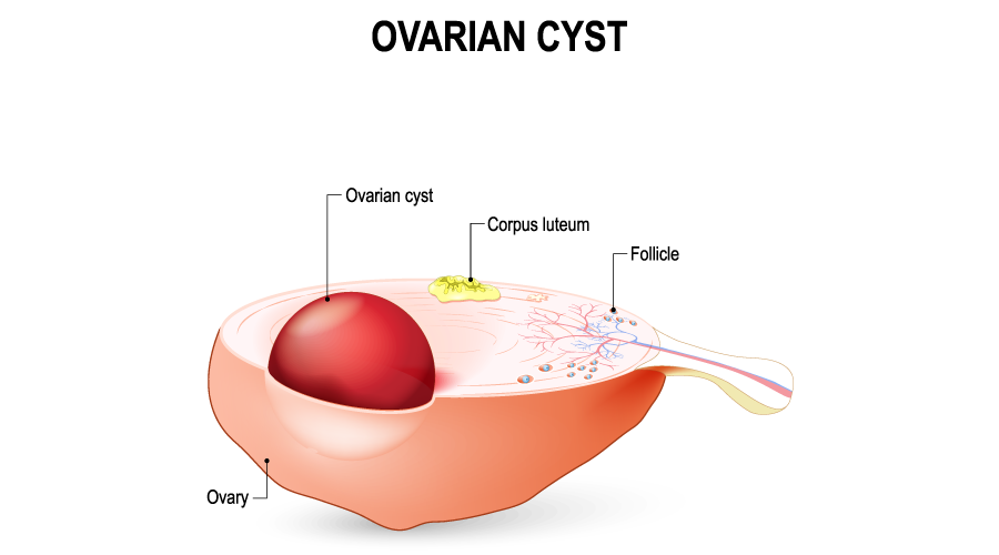 Ovarian Cysts Everything You Need to Know HealthKart