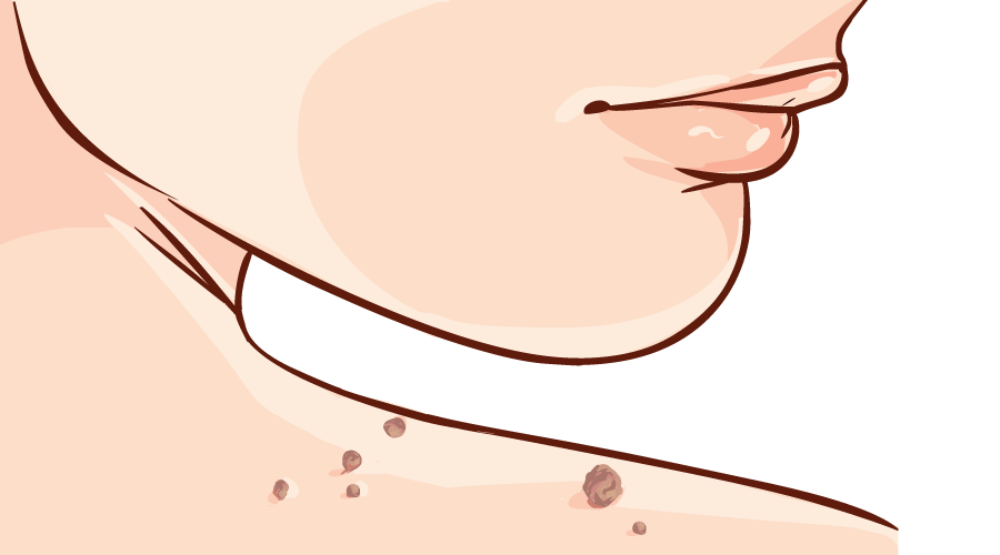 Skin Tag Know What It is and How It can be Treated HealthKart