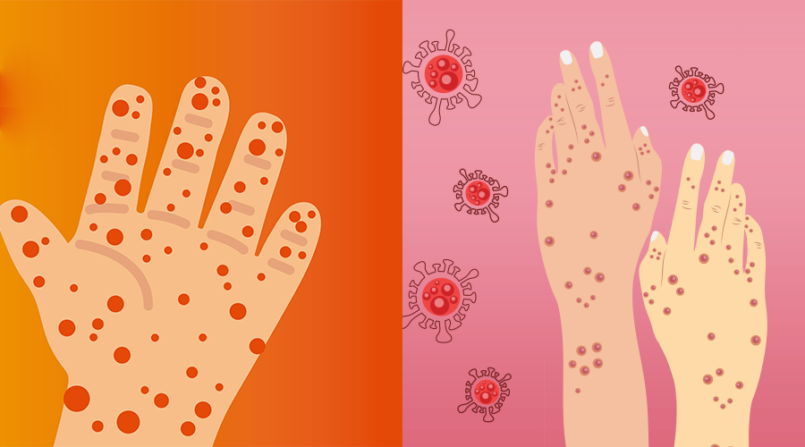 टोमेटो फीवर बनाम मंकीपॉक्स: वह सब जो आपको जानना आवश्यक है Tomato fever vs Monkeypox