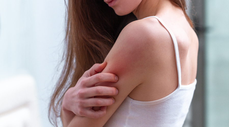 Heat Rash: How Does It Occur and What You can Do - HealthKart