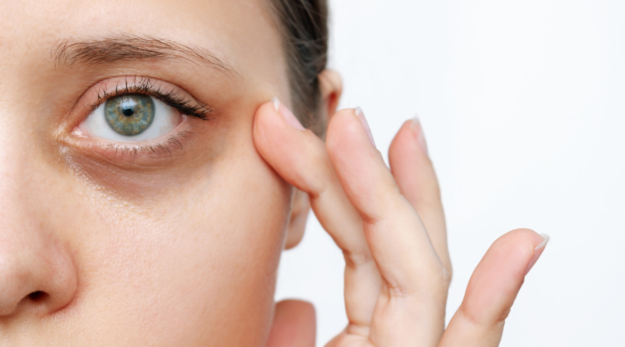 Causes Of Dark Circles Under Your Eyes HealthKart