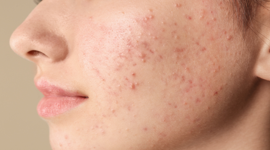 How To Remove Pimple Marks Easy Home Remedies HealthKart