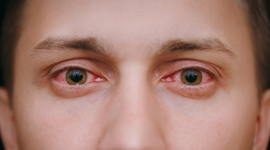 Red Eyes Causes, Remedies, And Prevention HealthKart
