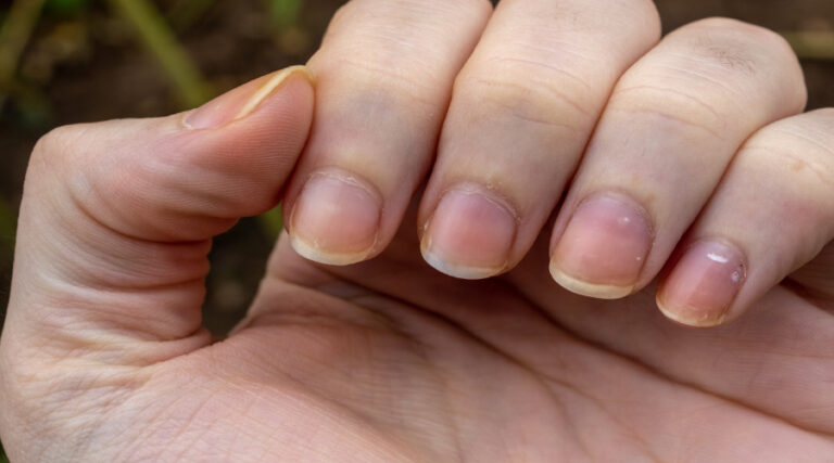 Yellow Nails and Health: What You Need to Know - HealthKart