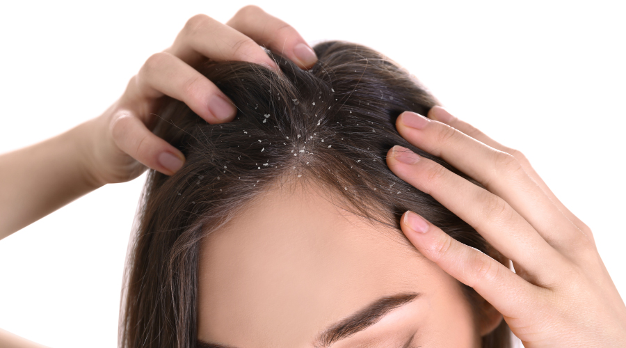 Dandruff vs Dry Scalp Know the Difference HealthKart