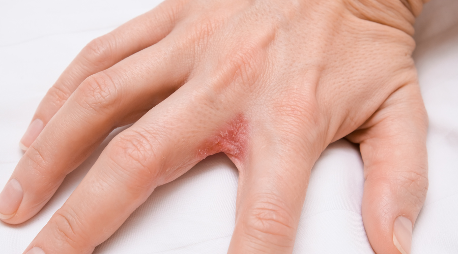 Managing Dyshidrotic Eczema Causes and Effective Therapies