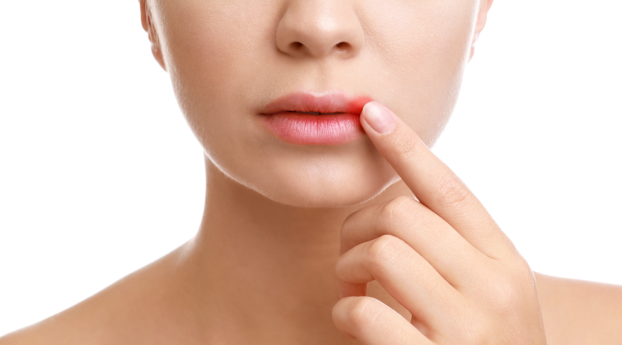 Cold Sores Here’s How to Deal with Them HealthKart