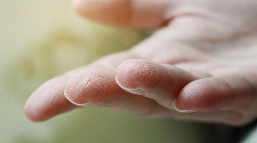 Dry Hands: Discussing the Causes and Remedies - HealthKart